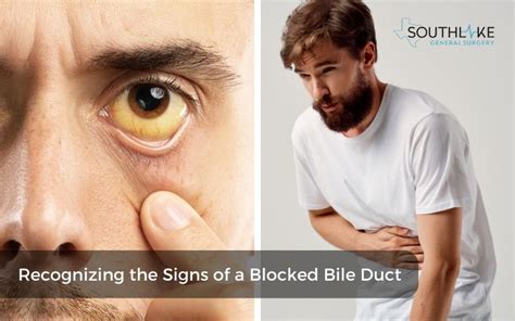 bile leakage symptoms|Draining blocked bile ducts